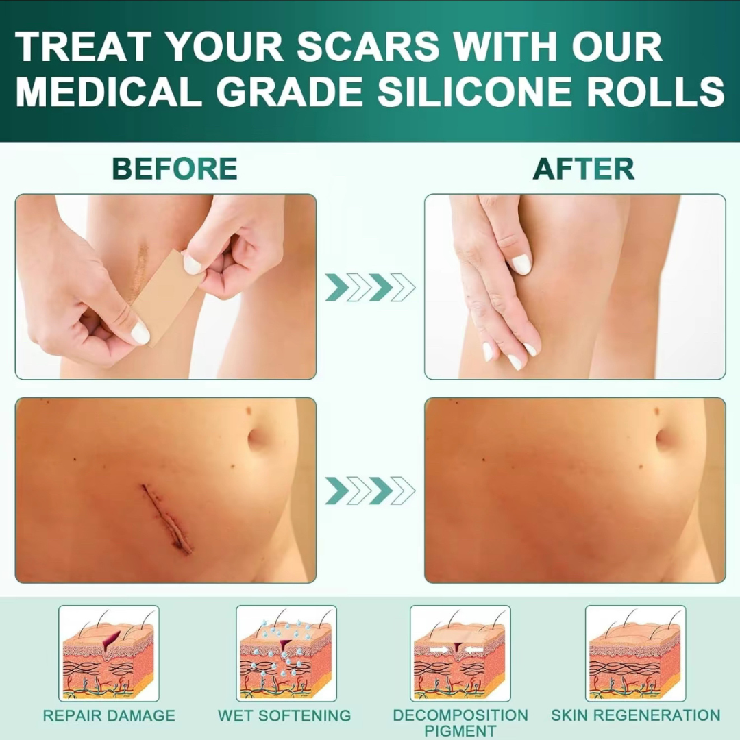 Silicone Scar Sheets